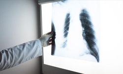 Erkeklerde En Sık "Akciğer", Kadınlarda Da "Meme Kanseri" Görülüyor