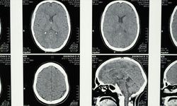 Araştırmalara Göre, Uykunun REM Evresine Geçişte Zorlanmak Alzheimer Belirtisi Olabilir